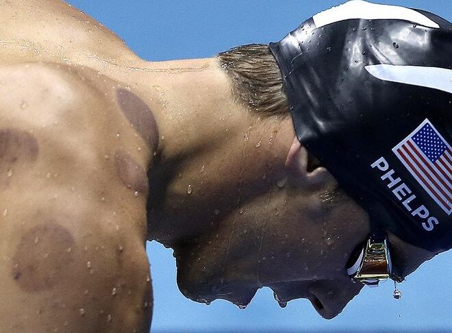 ?A qué se deben los círculos rojos en la espalda de Phelps?